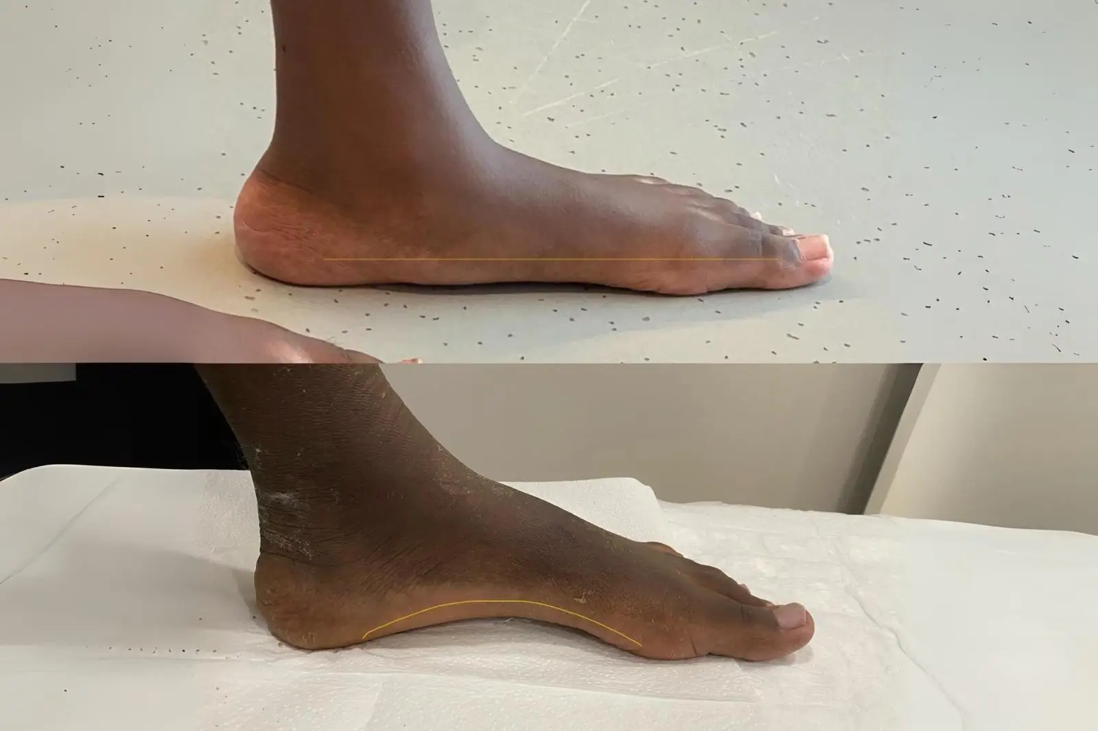 Knee Prosthesis Result 6