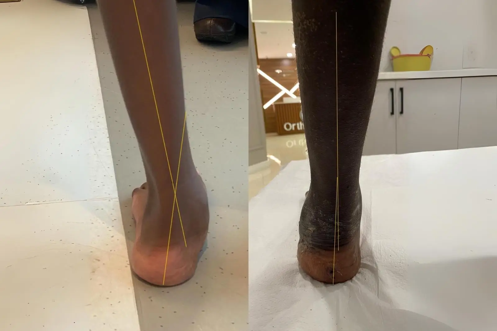 Knee Prosthesis Result 2