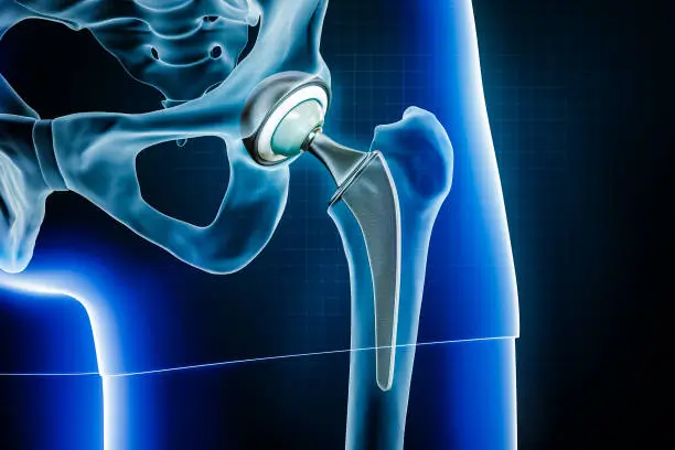 Kanalar Hip Prosthesis