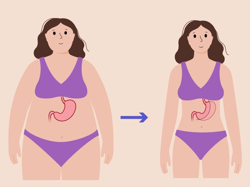 ¿Qué es la cirugía de manga gástrica?