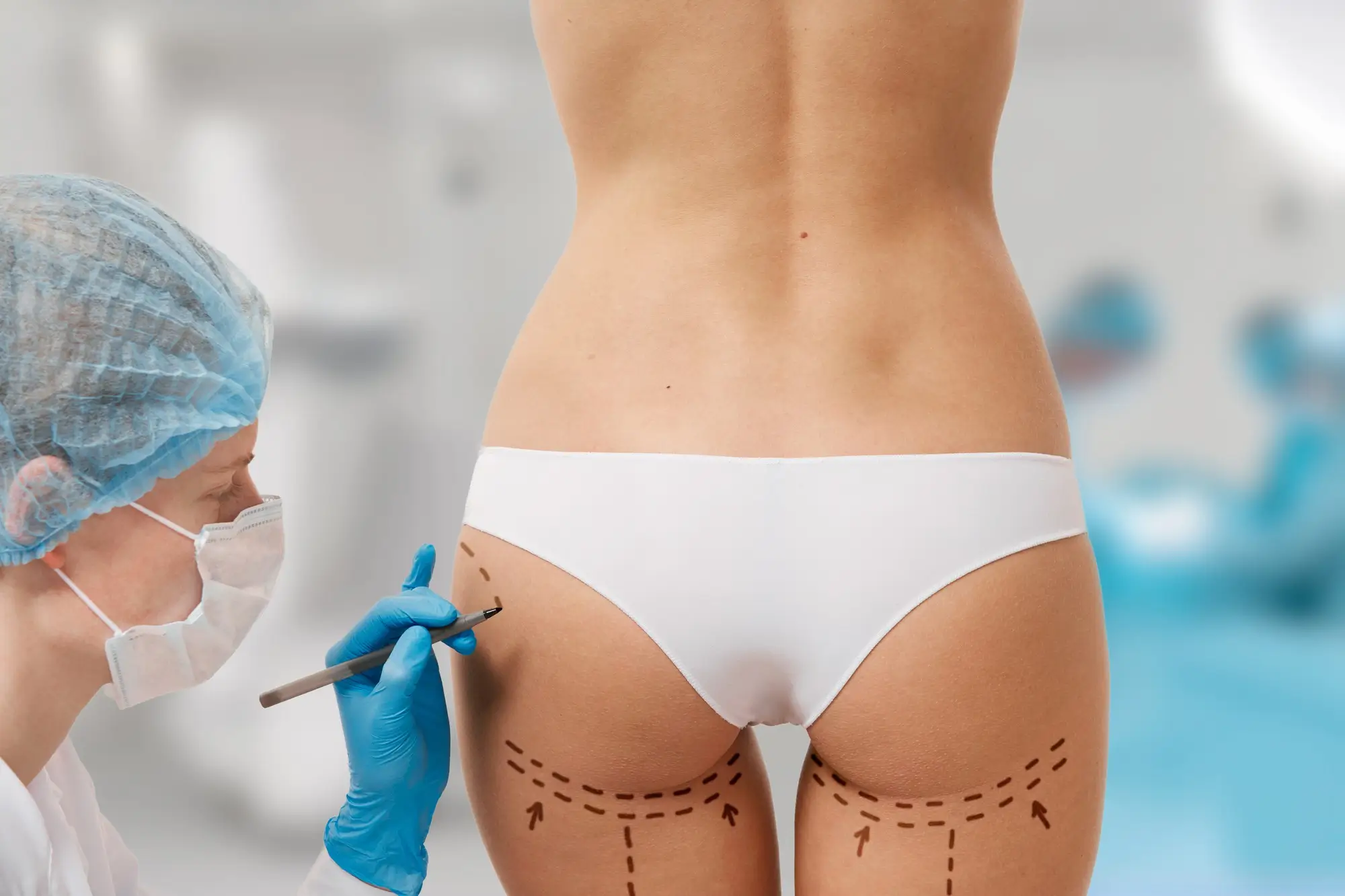 Butt Augmentation in Turkey | Aesthetic Hip Surgery - Kanalar Health