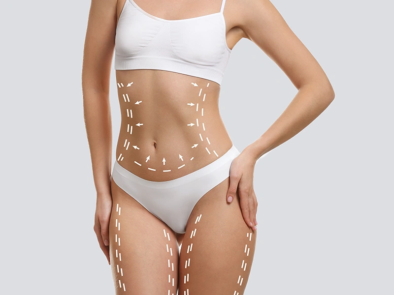 Что такое операция по подтяжке живота?