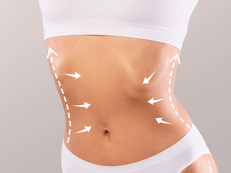 ¿Qué es un Mommy Makeover y cómo se realiza?