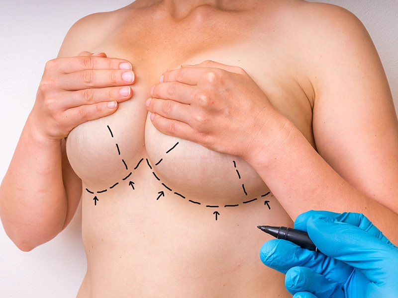 Чего ожидать от операции по подтяжке груди?