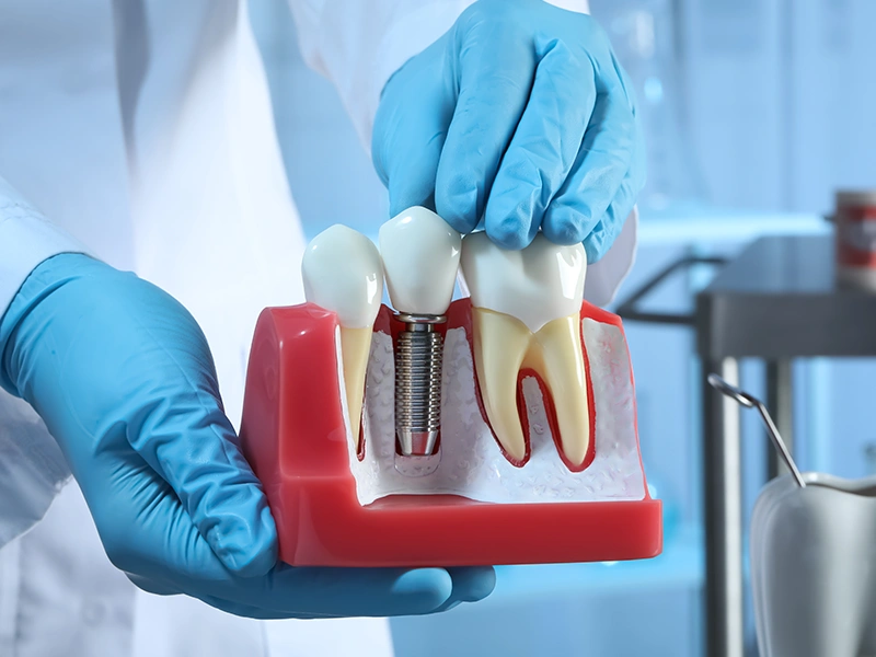 Why Choose Turkey for Dental Treatments?