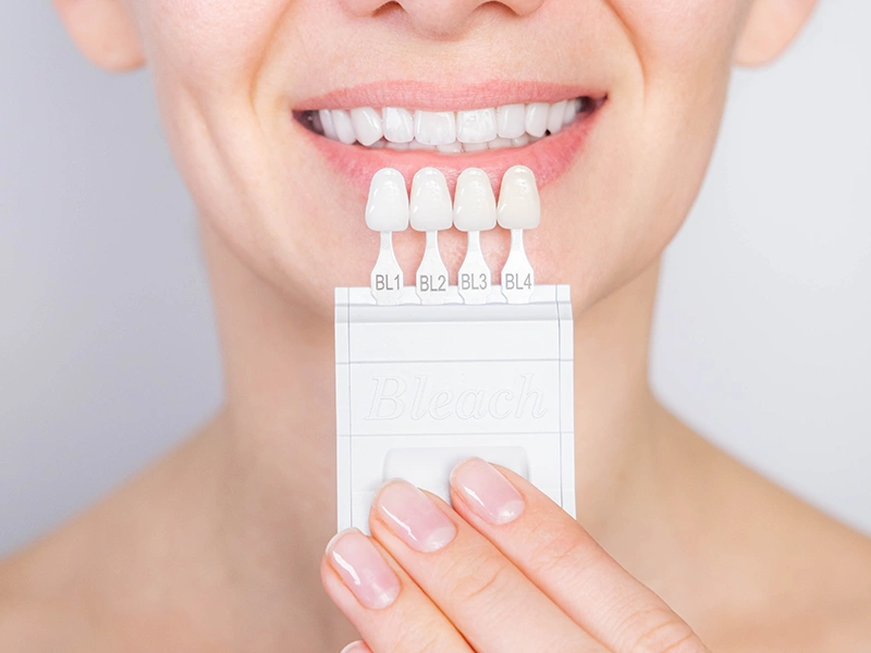 Una panoramica della procedura di faccette dentali: