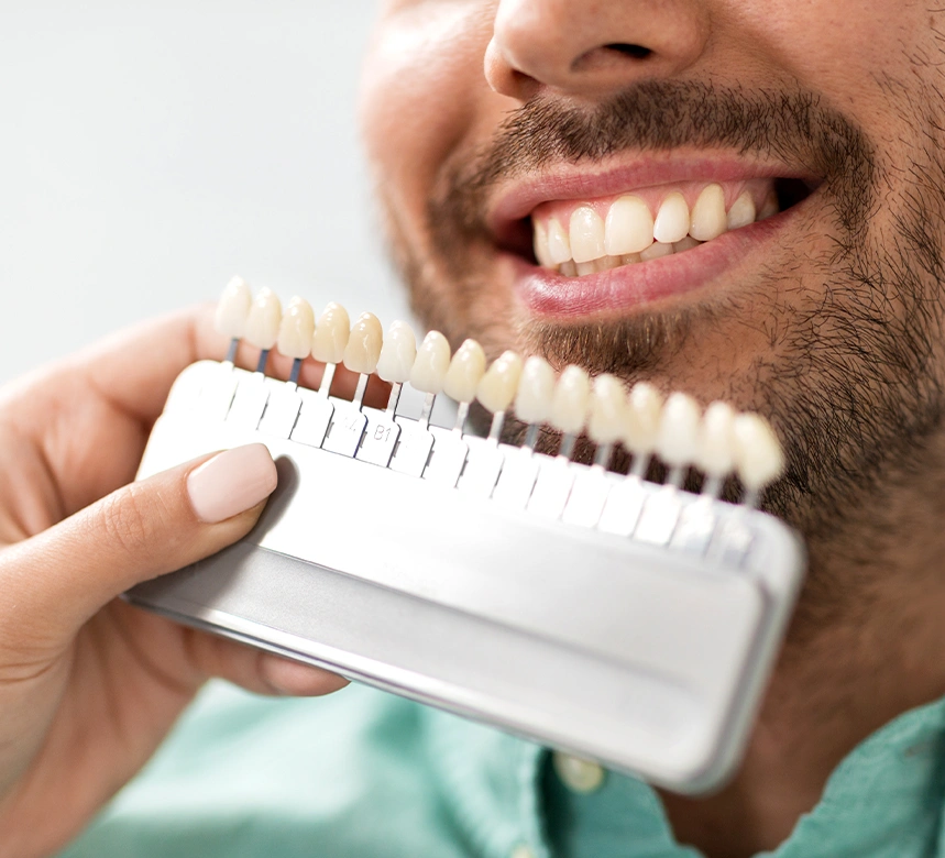 Vantaggi delle faccette dentali: