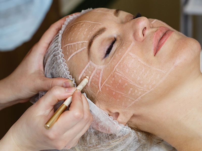 ¿Qué esperar de la cirugía de estiramiento facial?
