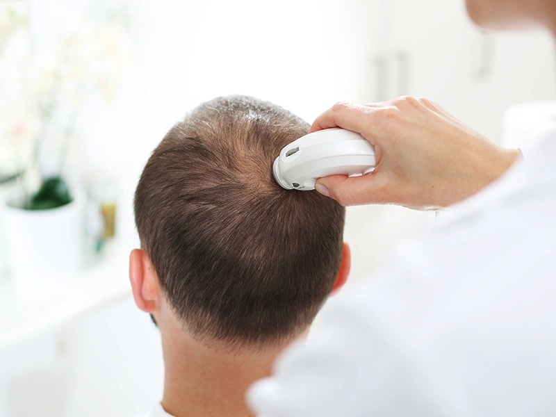 Qui sont les Bons Candidats pour une Greffe de Cheveux ?