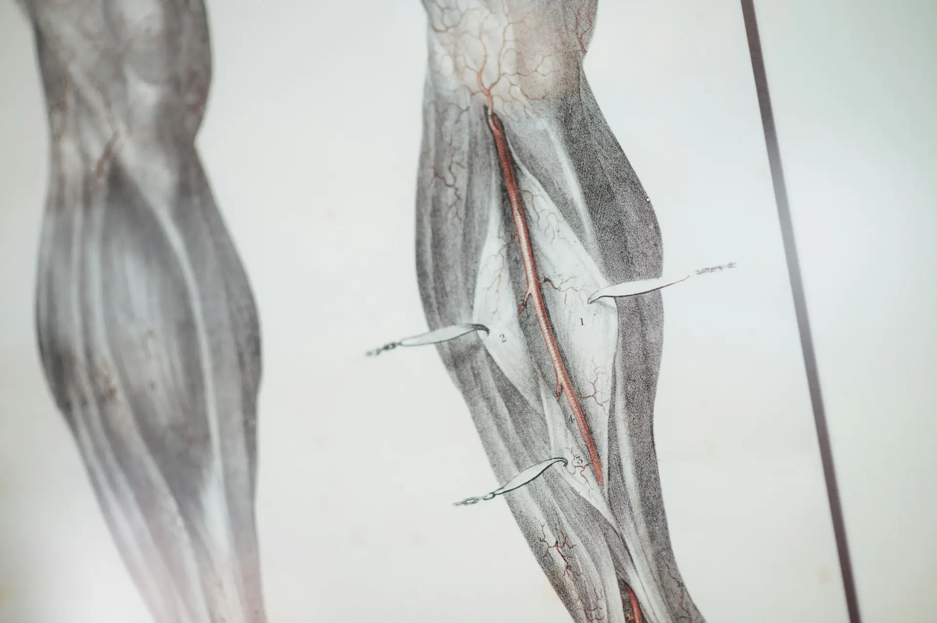 Types of Meniscus Tears