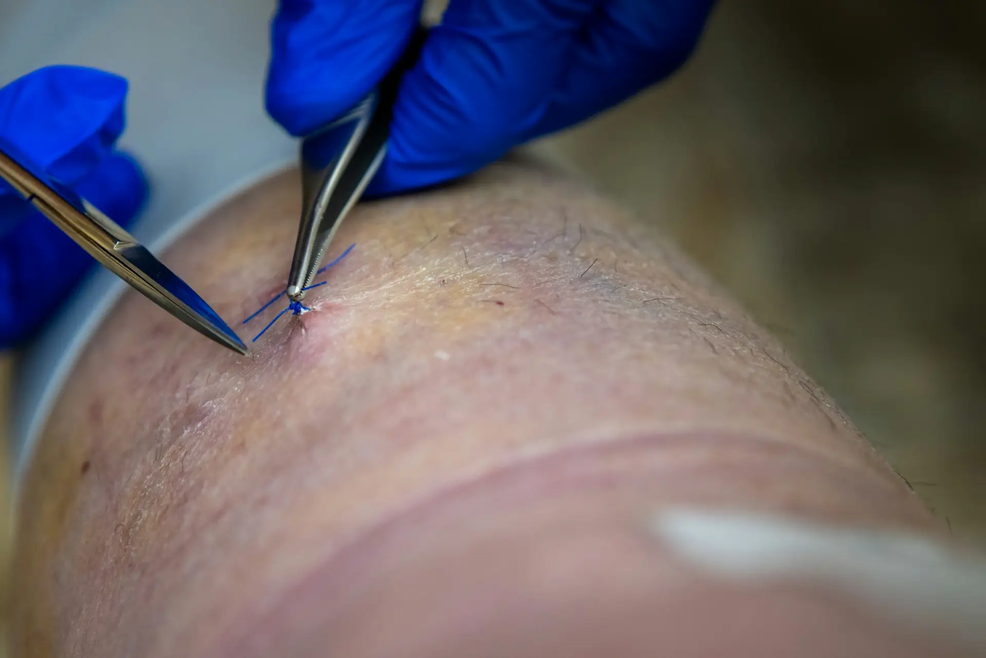 How is meniscus surgery performed?
