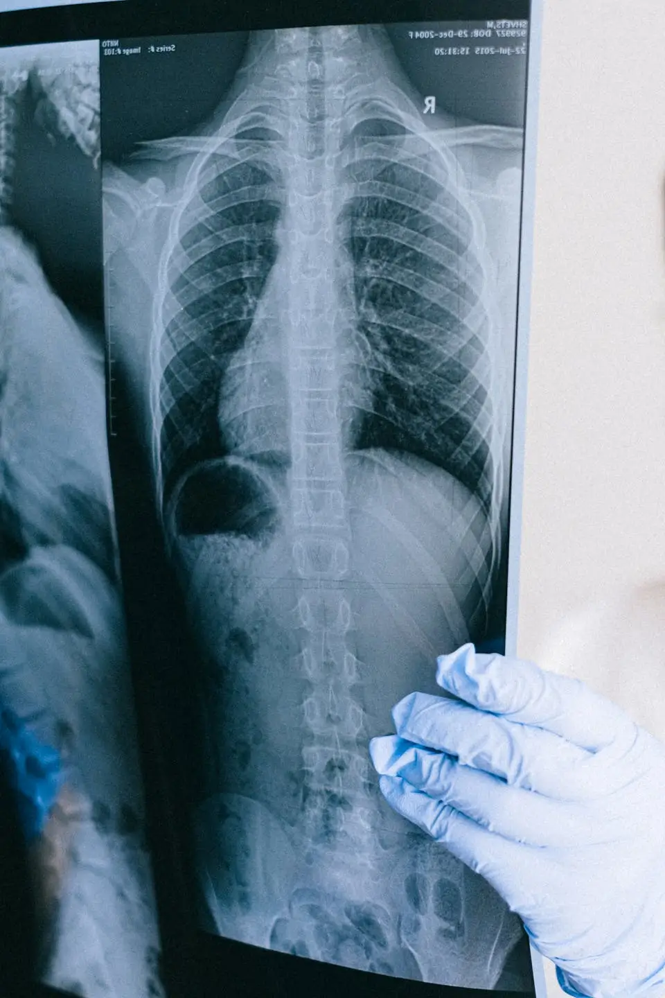 scoliosis.operation-what